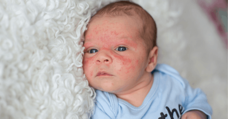 breastfed baby has eczema