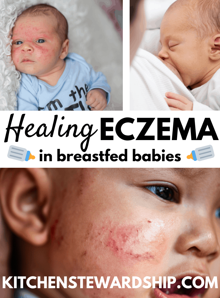 healing eczema in breastfed babies