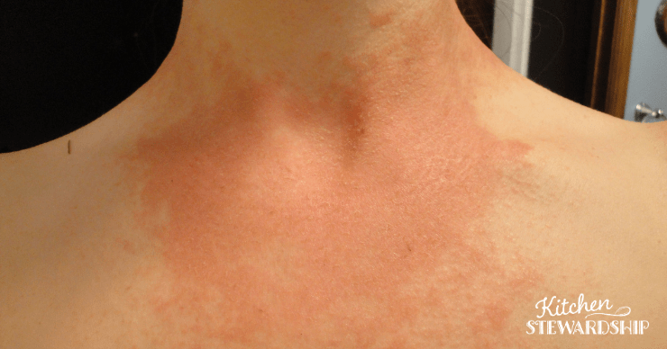 awful candida rash on neck