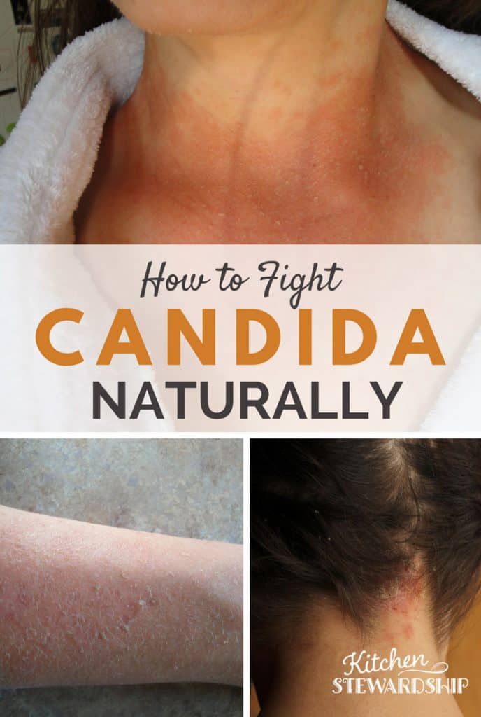 Simple, natural remedies for an itchy candida skin rash. Starve it!!
