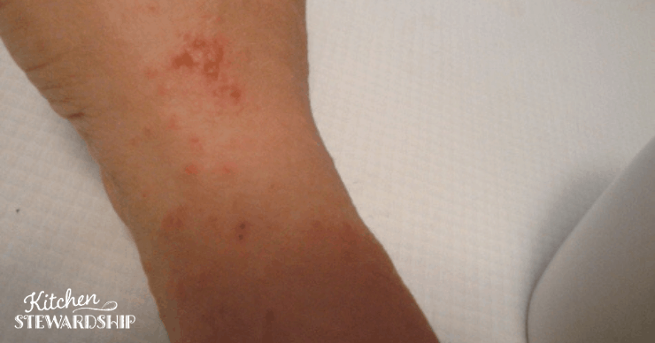 Candida rash on back of wrist