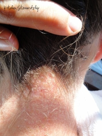 3 Steps to Fighting Candida Naturally