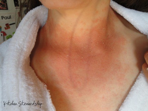 3 Steps to Fighting Candida Naturally