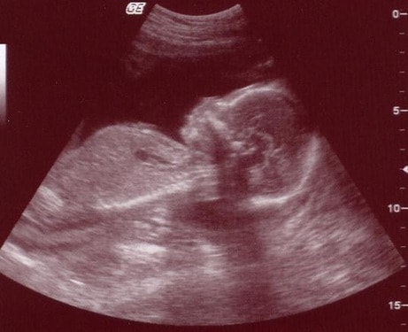ultrasound unborn child