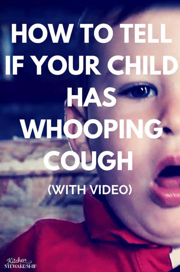Signs, symptoms, and severity of whooping cough