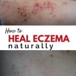 It is possible to heal your eczema naturally! I've got simple tips to find triggers, foods to eliminate and how to get to the root cause.