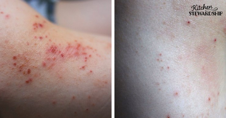 A before and after picture of treating eczema naturally. 