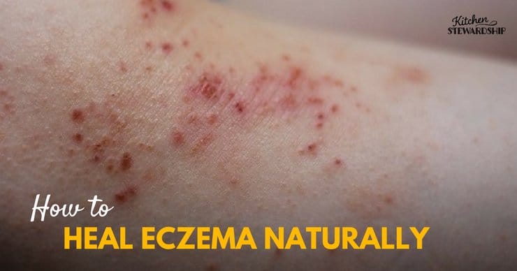 It is possible to heal your eczema naturally! I've got simple tips to find triggers, foods to eliminate and how to get to the root cause.