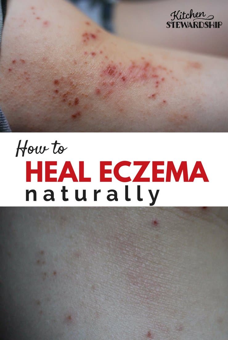 How to heal eczema naturally. Before and after pictures of treating eczema naturally.