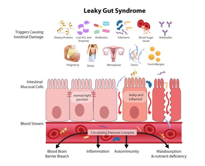 Showing what leaky gut syndrome looks like and the main triggers. 