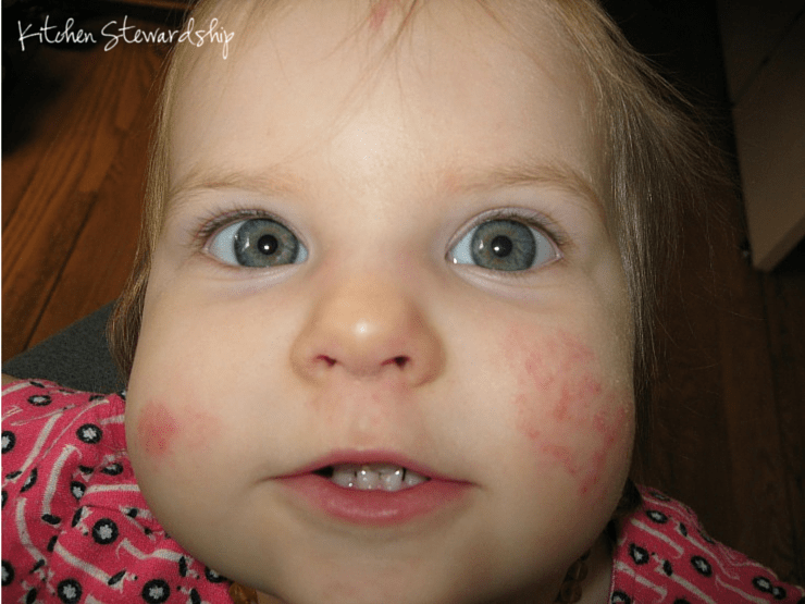 Does eczema plague your family? Check out our list of what works and what doesn't to soothe scratchy skin.