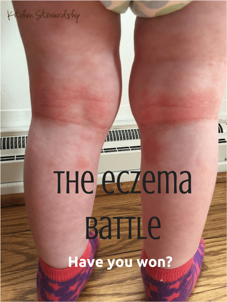 Does eczema plague your family? Check out our list of what works and what doesn't to soothe scratchy skin.