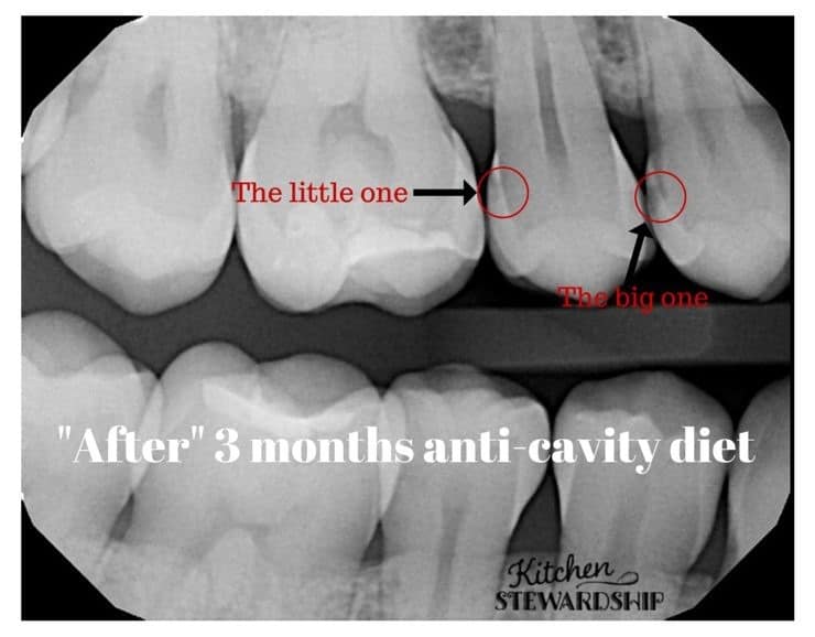 Cavities after 3 months anti cavity diet to heal tooth decay