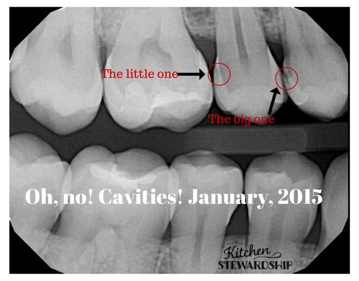 Discovering cavities in my mouth January