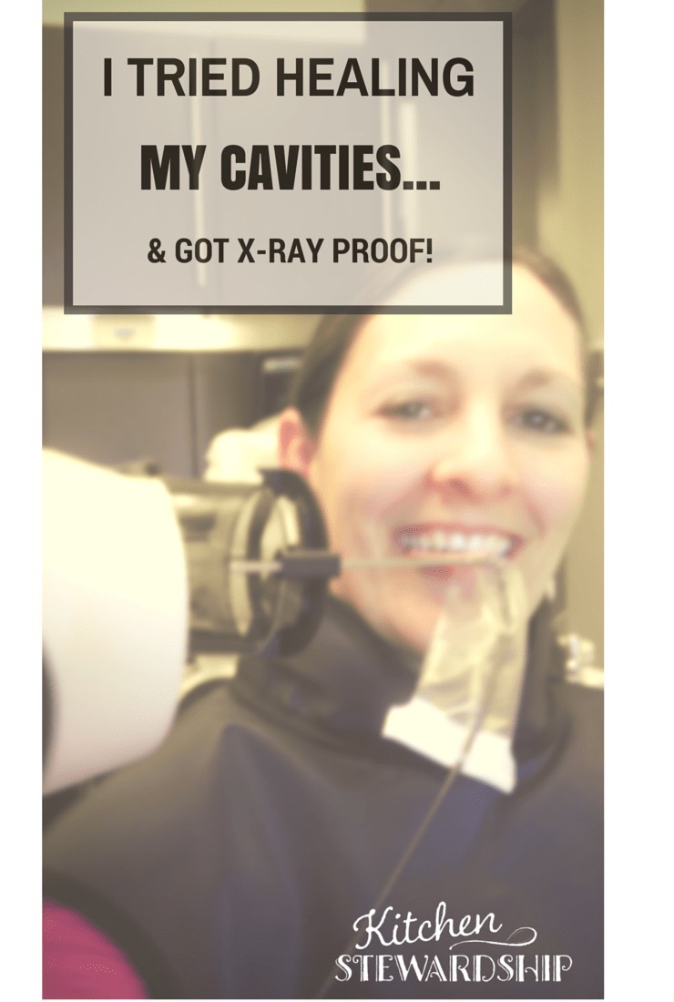 I tried healing my cavities and got X ray proof