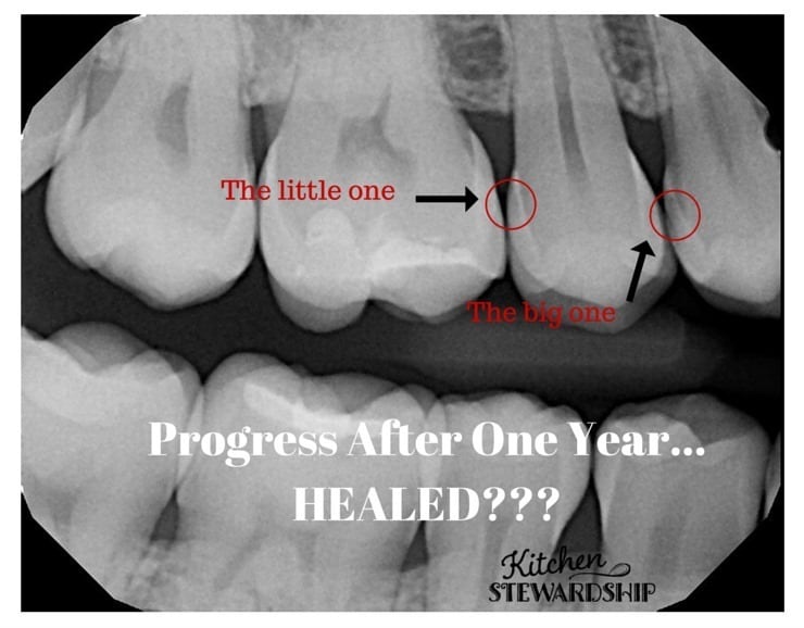 Cavity healing progress after one year it is possible to heal cavities and reverse tooth decay