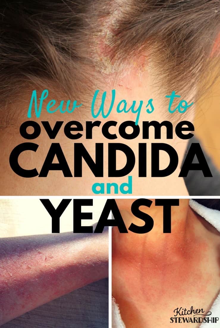 New Ways to Overcome Candida and Yeast