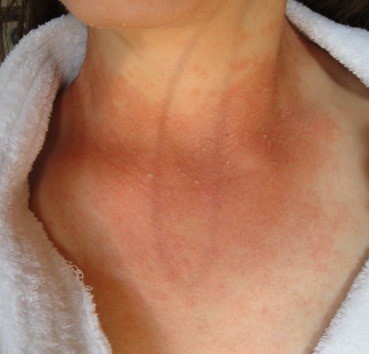 candida rash for facebook