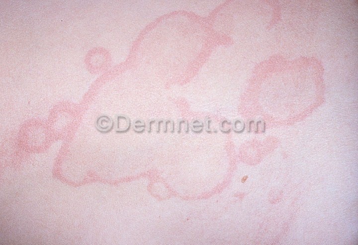 erythema annulare centrifugum