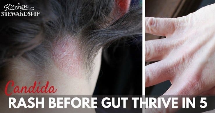 Candida rash before starting Gut Thrive in 5 a gut healing diet