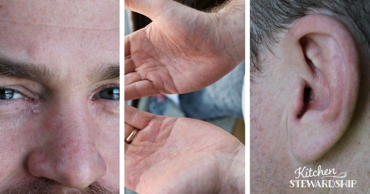 Eczema on eyes hands and ears before starting Gut Thrive in 5 a gut healing protocol