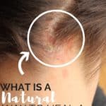 What is a natural way to heal candida rash?