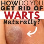 How do you get rid of warts naturally?