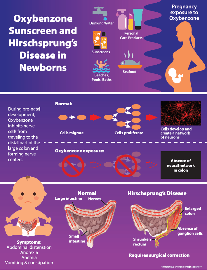 Hirschsprung's Disease may be caused by sunscreen ingredient oxybenzone