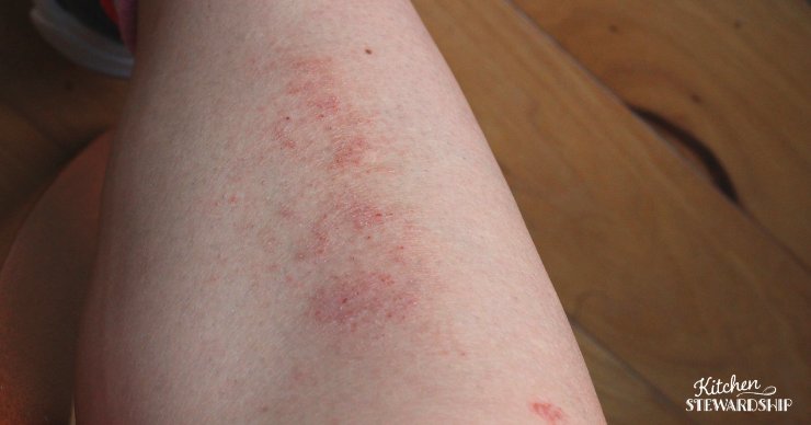 Rash on arm