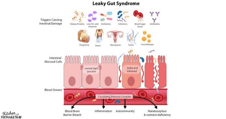 leaky gut