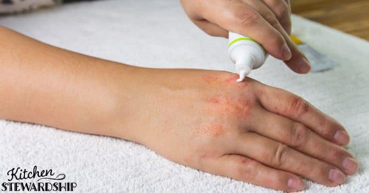 steroid cream on hand