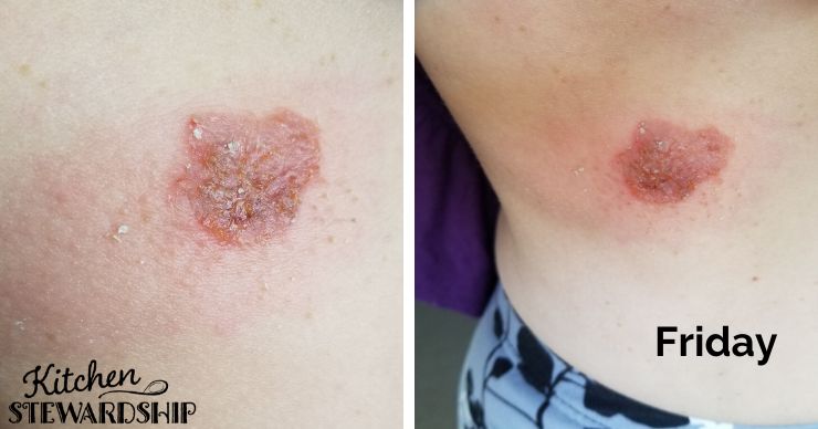 Cellulitis rash on Friday