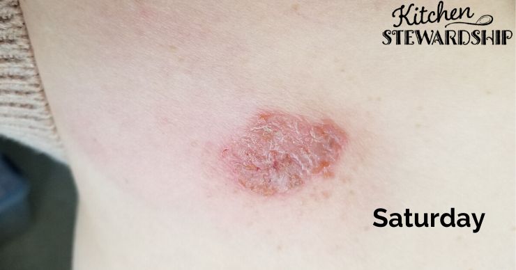 skin infection photo