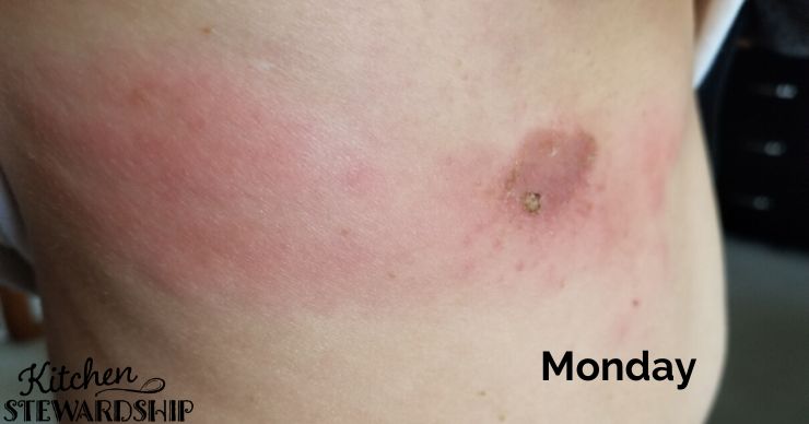 Skin infection cellulitis