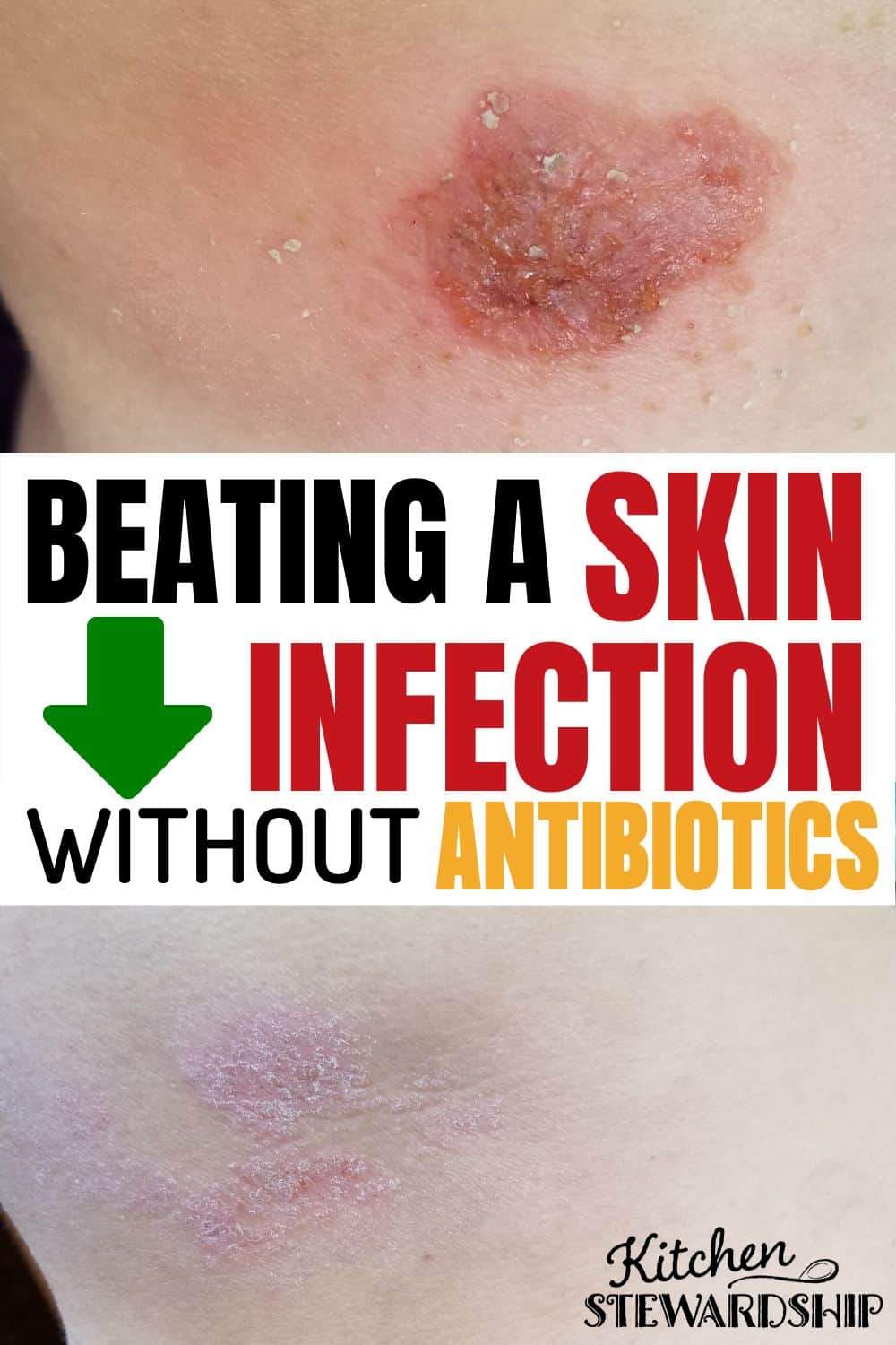 beating a skin infection without antibiotics