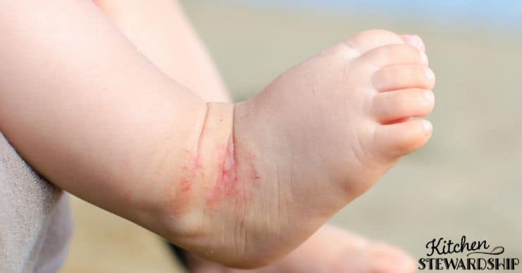 eczema on a babies foot