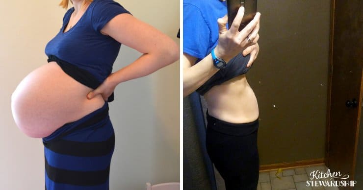 Diastasis recti in pregnancy