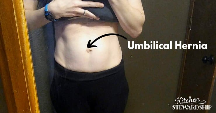 umbilical hernia