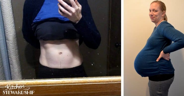 diastasis recti pictures