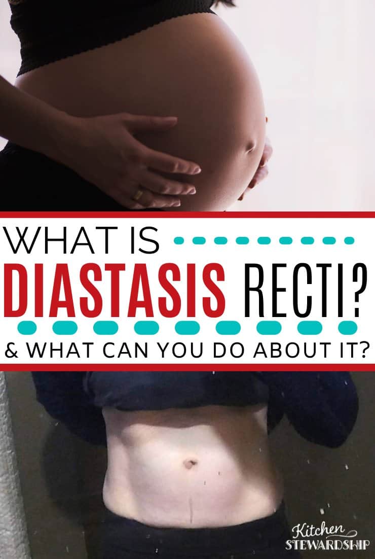 what is diastasis recti?