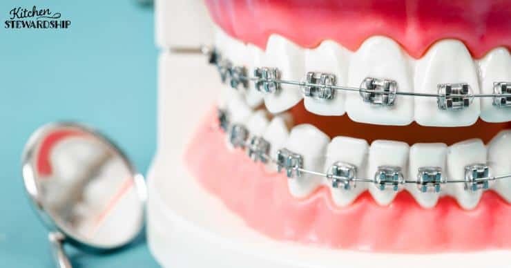 Dental braces