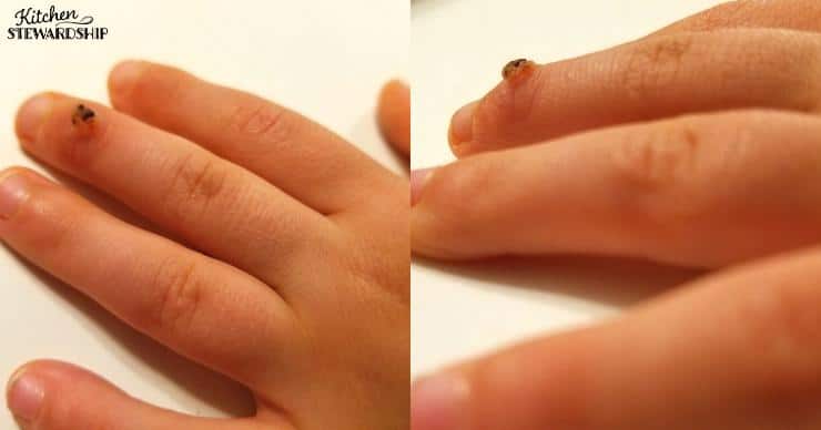wart on a child's hand