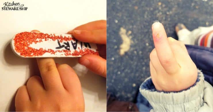 Wart on child's hand healing, dedicated wart filing stick