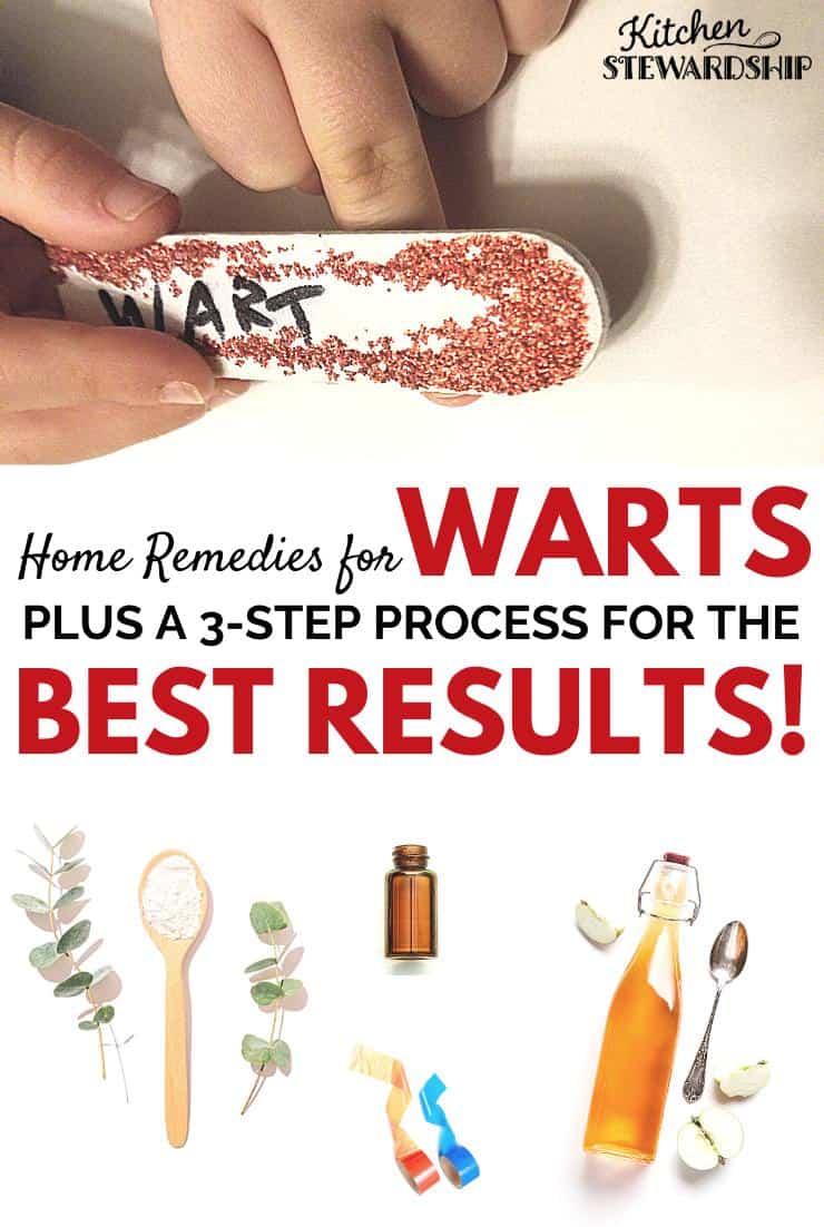 Home remedies for warts plus a 3-step process for the best results. remove warts home remedy, warts remedies natural