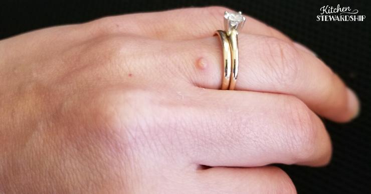 Common wart on woman's ring finger, warts remedies natural