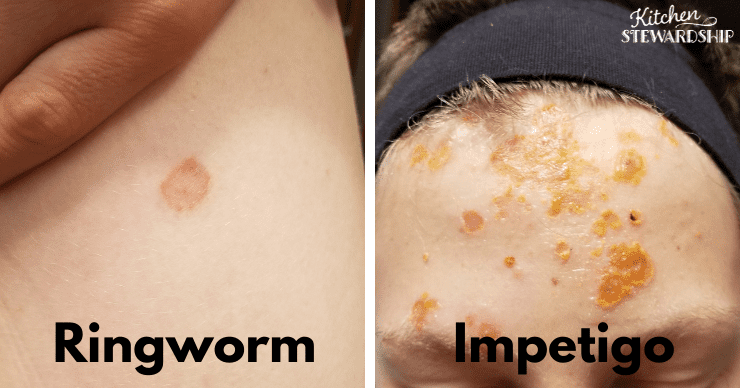 ringworm vs impetigo