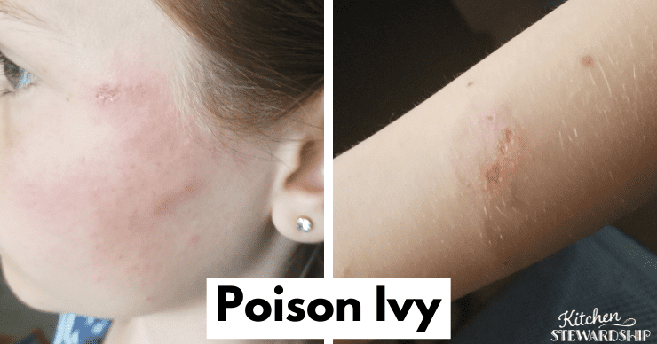 poison ivy rash