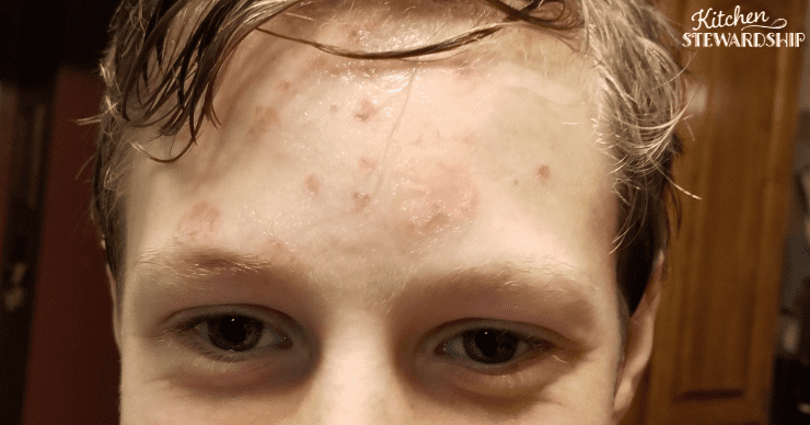 healing impetigo