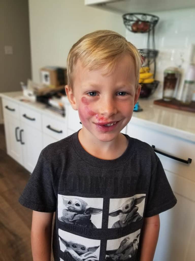 Gabe's biking inhury